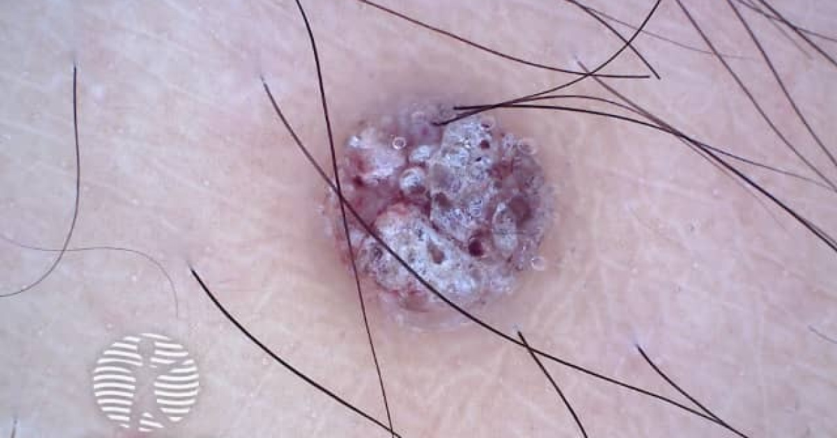 Dermoscopy of angiokeratoma of Fordyce on vulva image