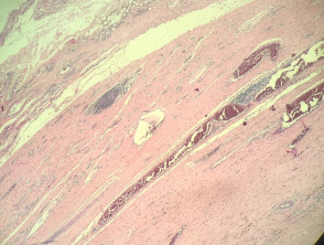 Angiomatoid fibrous histiocytoma