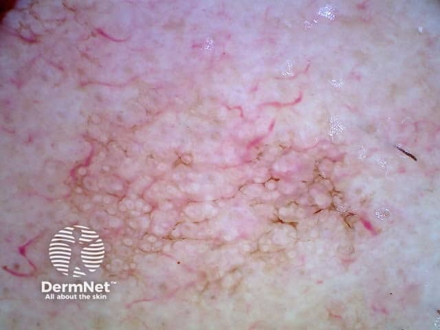 Asymmetrical pigmented follicular openings in pigmented actinic keratosis dermoscopy