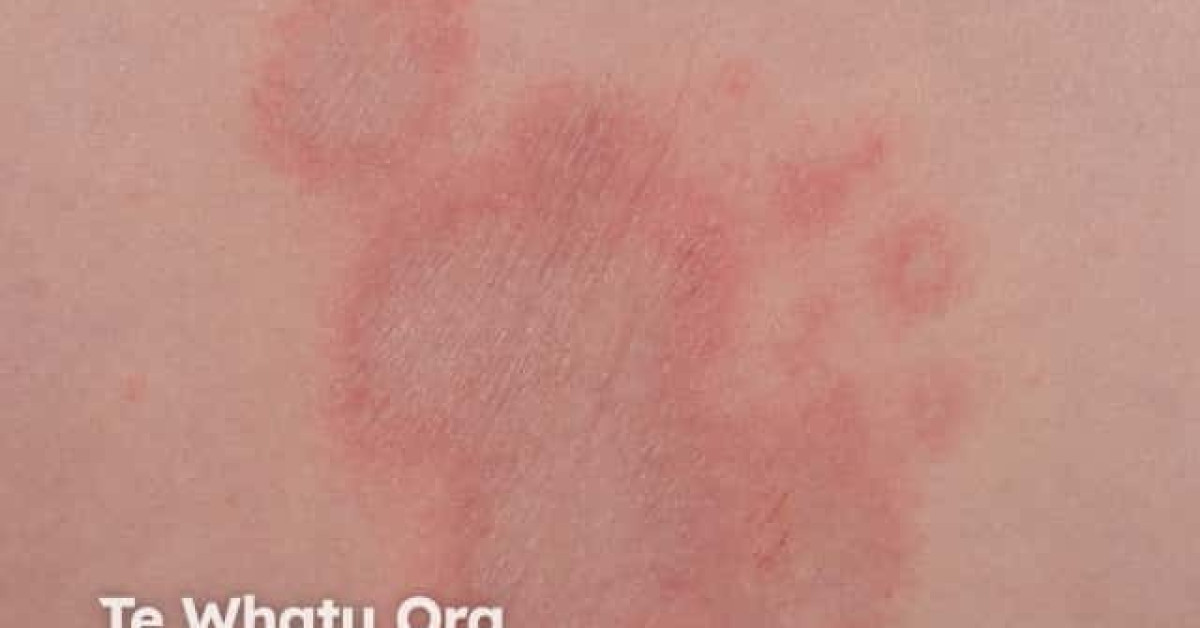 DermNet® - Erythema annulare centrifugum image