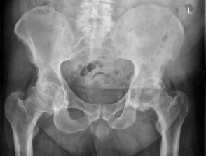 X-ray of AP view of pelvis with psoriatic arthritis