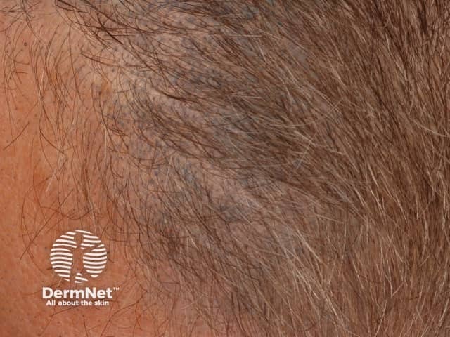Blue discoloration of scalp skin