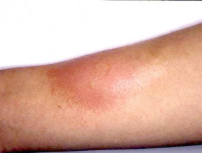 wasp sting infection signs