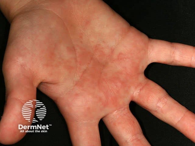 Hand irritation from contact with caterpillars