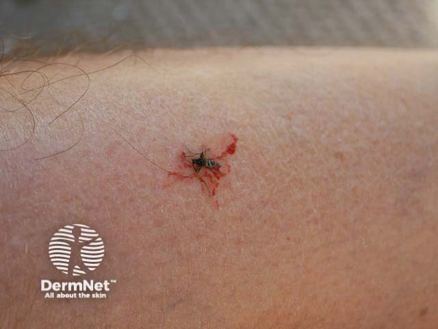Insect bite