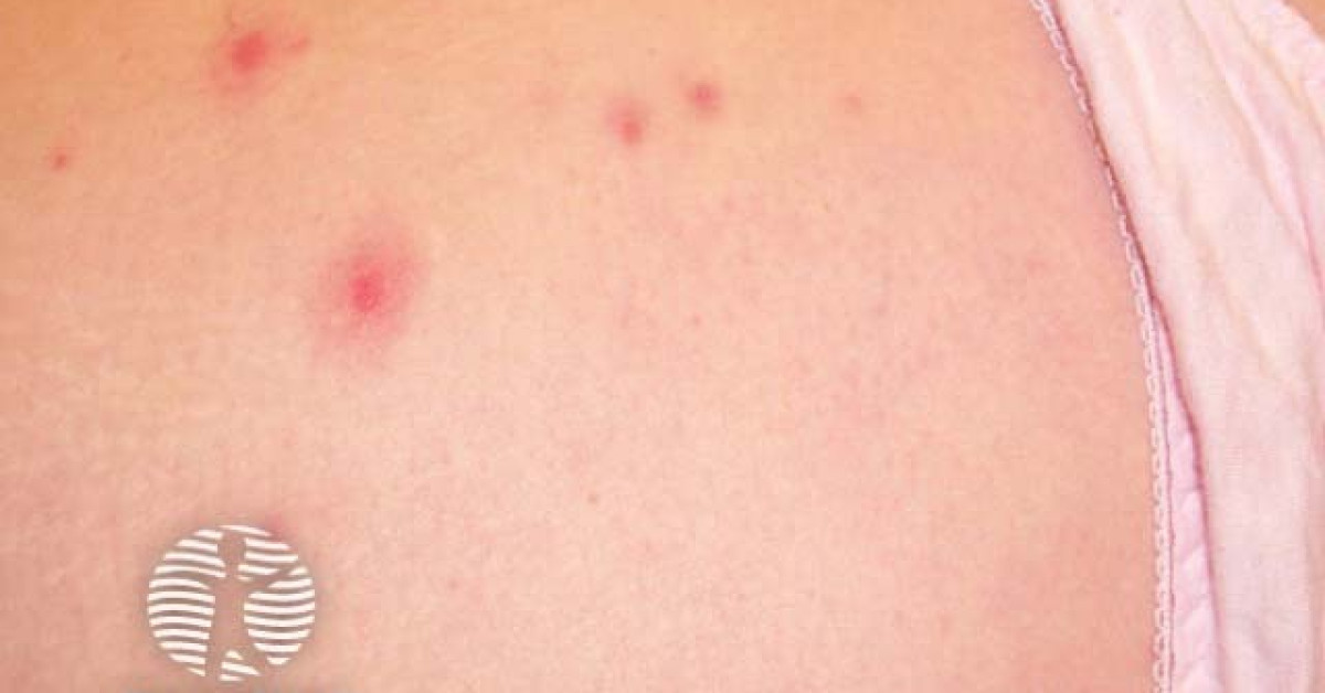 Insect bite image