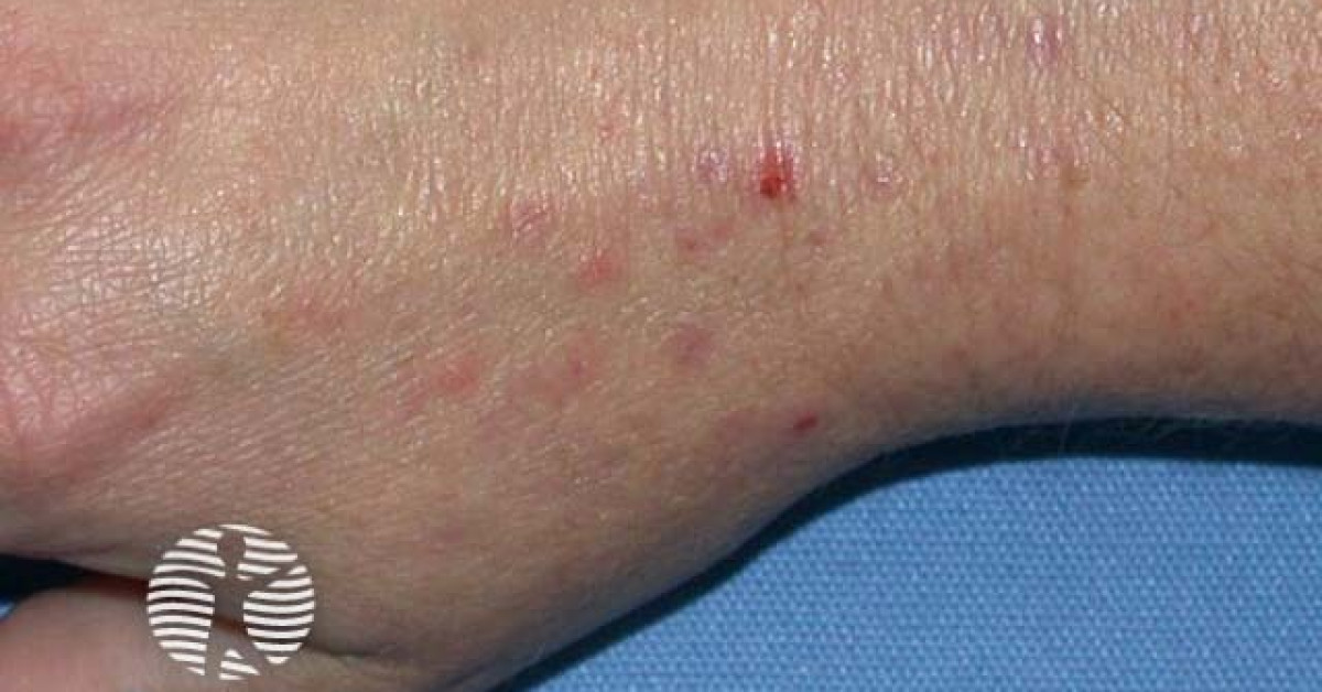 Insect bite image