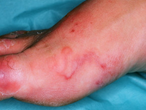 hookworm rash