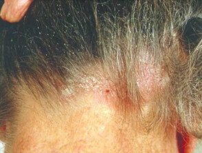 Head lice and dermatitis