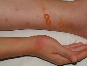 sand flea bites on children