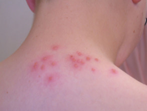 Scabies Pictures Of Hives