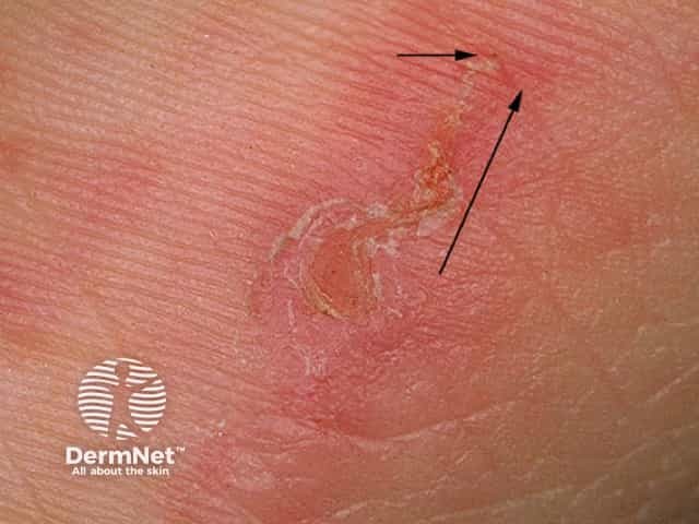 Scabies Burrows