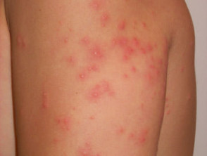 swimmers itch bites