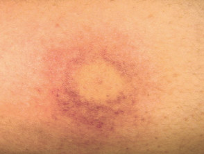 Wasp sting reaction causing localised vasculitis with purpura