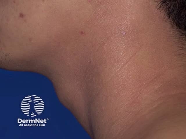 Atopic dermatitis of neck