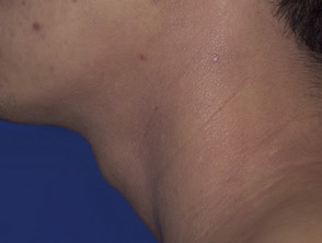 Atopic dermatitis of neck
