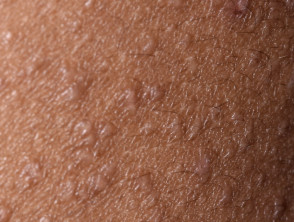 Close up of follicular atopic dermatitis