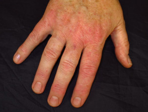 Itchy dermatitis of the hand