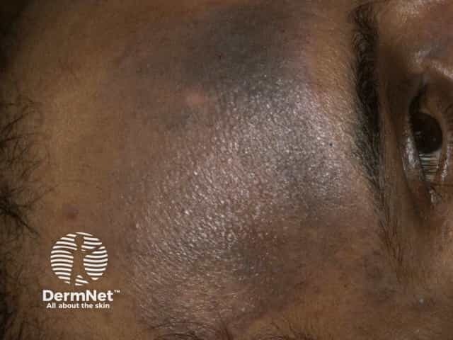 Hyperpigmentation due to atopic dermatitis