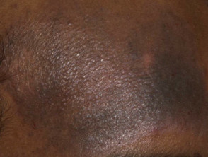 Hyperpigmentation due to atopic eczema in black skin