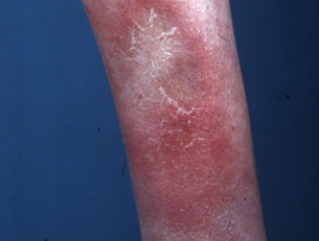 tuberculosis skin symptoms