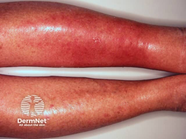 A swollen tender hot left leg due to Streptococcal cellulitis
