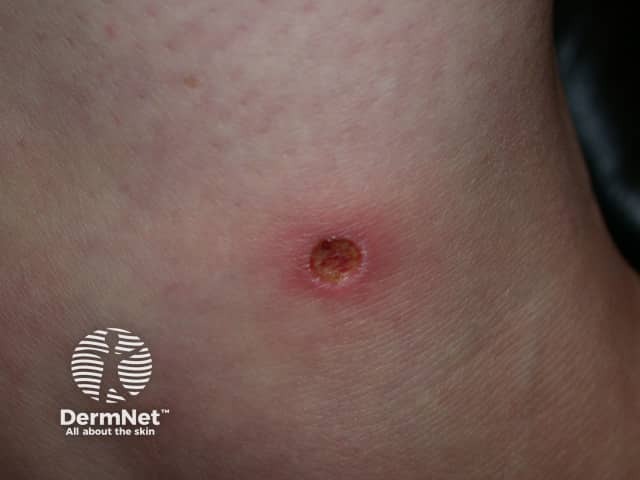 Ecthyma Impetigo Dermatologic Bacteriology Plastic Surgery Key