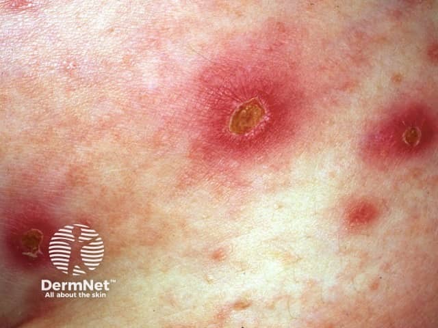 Ecthyma Impetigo Dermatologic Bacteriology Plastic Surgery Key Ecthyma Impetigo Dermatologic Bacteriology Plastic Surgery Key