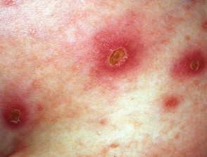 streptococcus skin