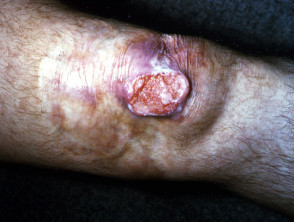 Cutaneous tuberculosis: lupus vulgaris with squamous cell carcinoma