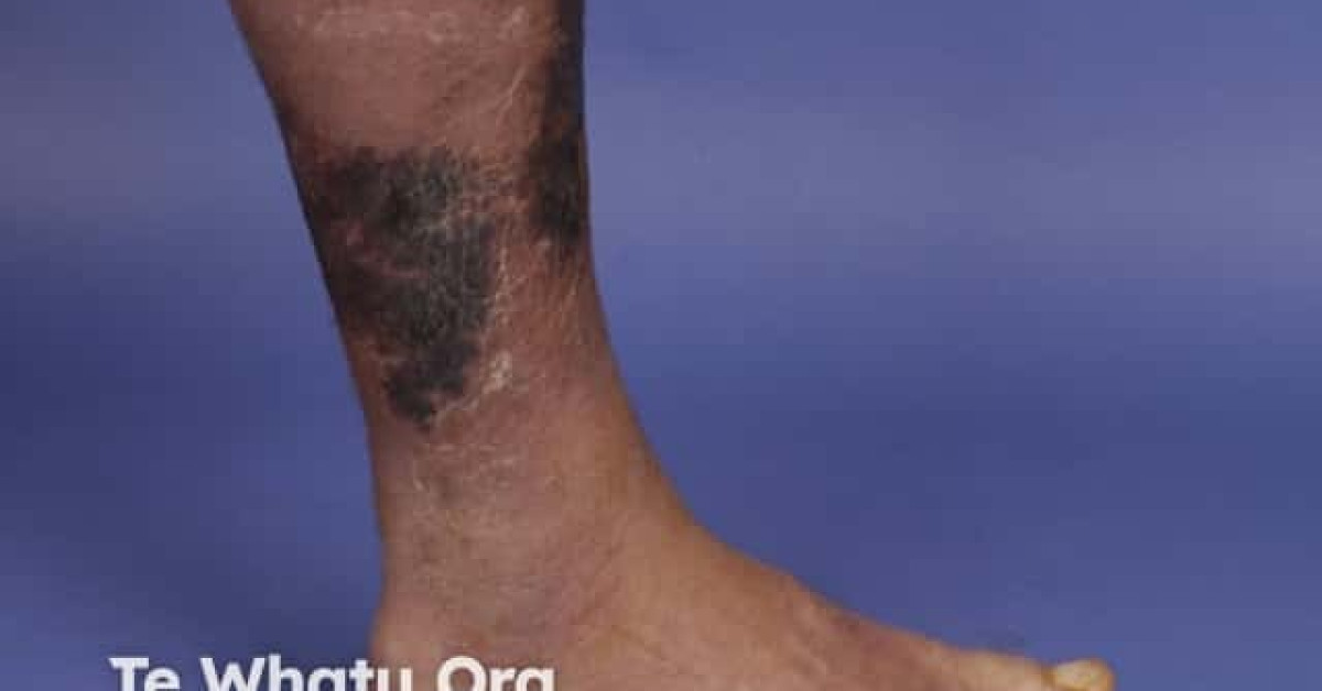 Necrotising fasciitis image