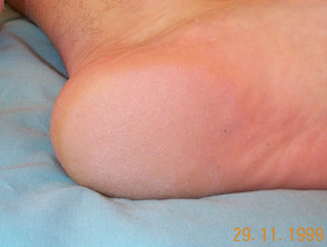 white skin on heel of foot