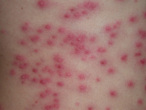 Pseudomonas skin infections | DermNet