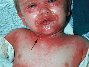 scalded skin syndrome