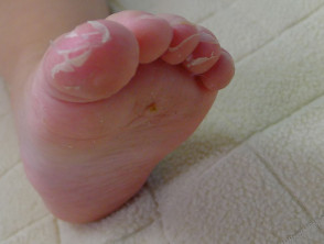 Peeling toes after scarlet fever
