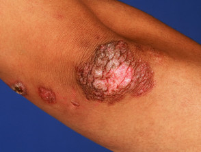 Lupus vulgaris/looks like tuberculosis verrucosa cutis to me