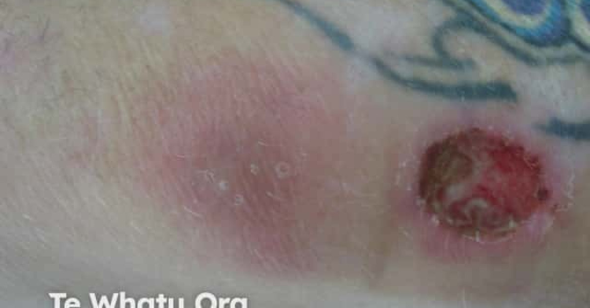 Mycobacterium chelonae image