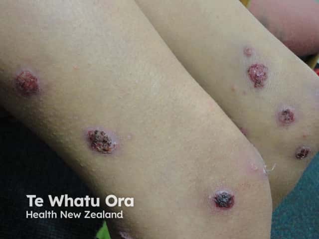 Ecthyma Ecthyma