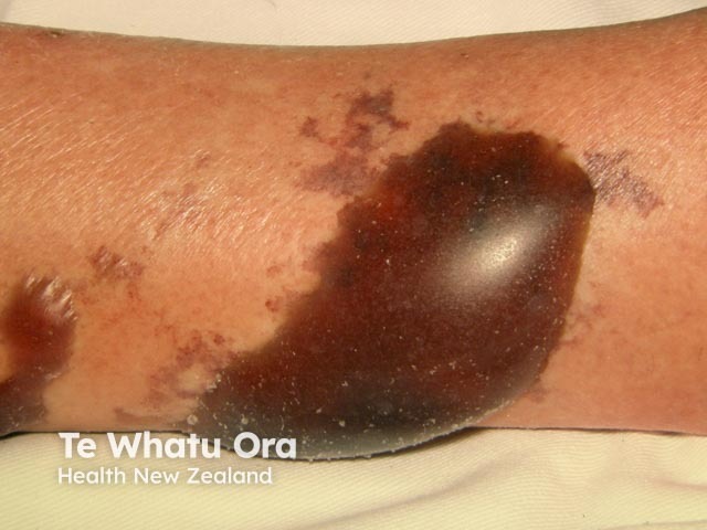 Necrotising skin infection