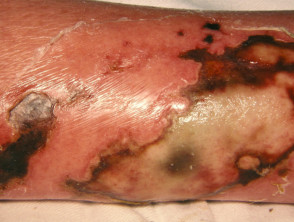 Necrotising skin infection