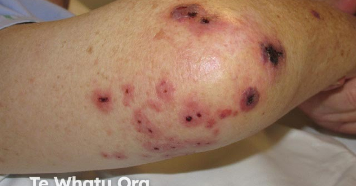 Septic Diffuse Rash Septic emboli image