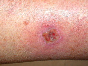 surgical wound infection