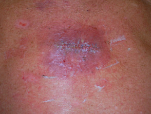 Staphylococcal skin infections | DermNet NZ