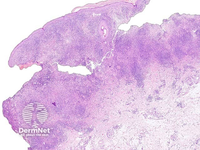 Figure 2. Balamuthia mandrillaris pathology