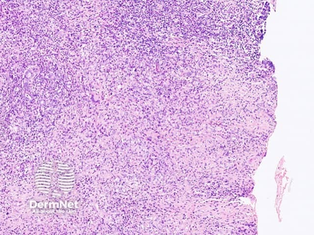 Figure 3. Multinucleate giant cells free in the dermis, outside of the loose granulomas
