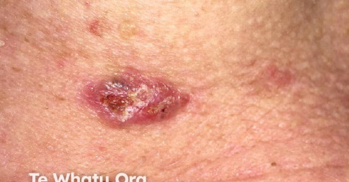 Basal cell carcinoma image