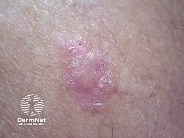 Basal cell carcinoma affecting the arms and legs 10 macro