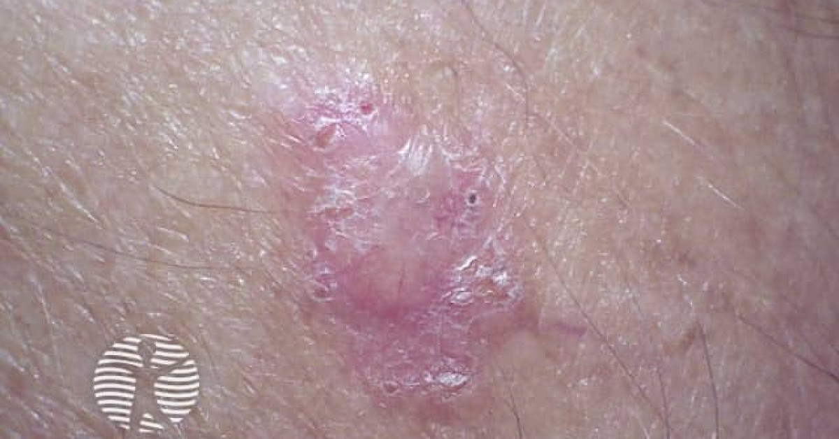 Nodular basal cell carcinoma image