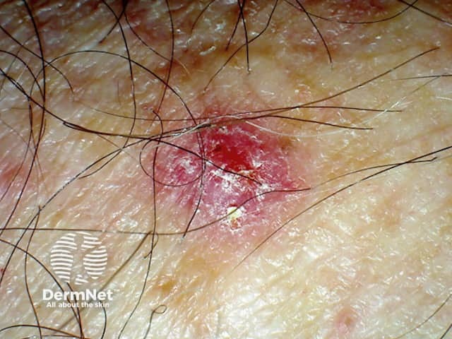 Basal cell carcinoma affecting the arms and legs 11 macro