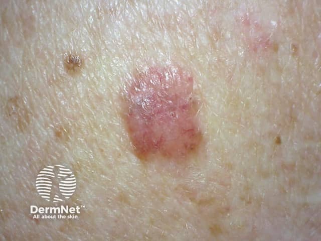 Basal cell carcinoma affecting the arms and legs 1 macro